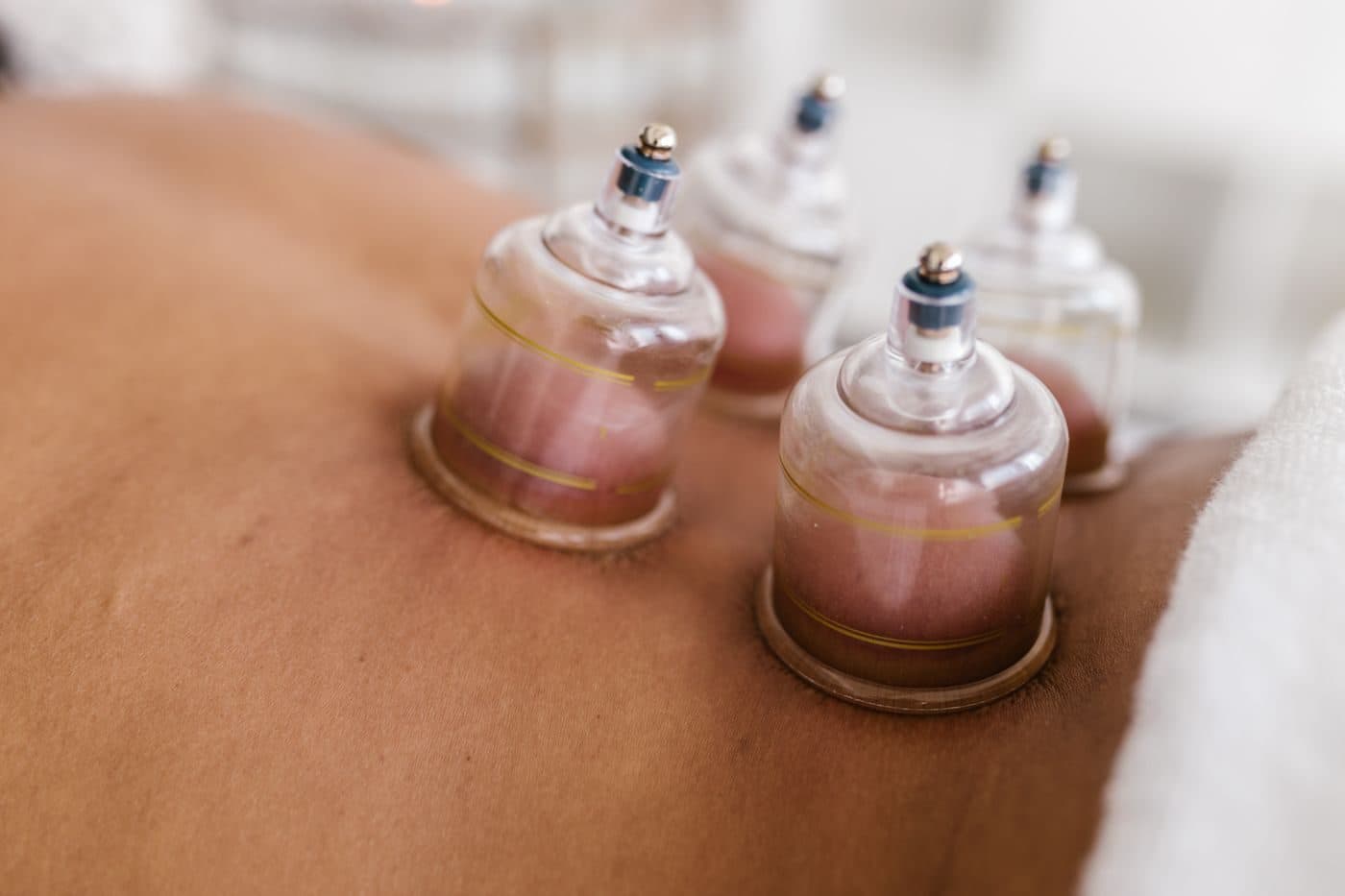 Ventouses de hijama posées sur le dos d’un patient